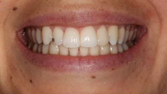 Caso clínico Invisalign