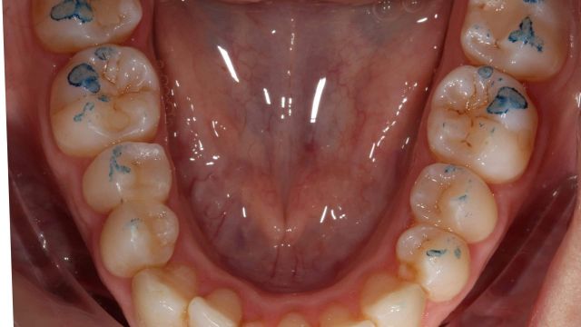 Caso clínico Invisalign