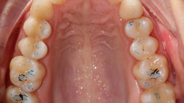 Caso clínico Invisalign