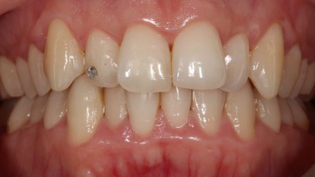 Caso clínico Invisalign