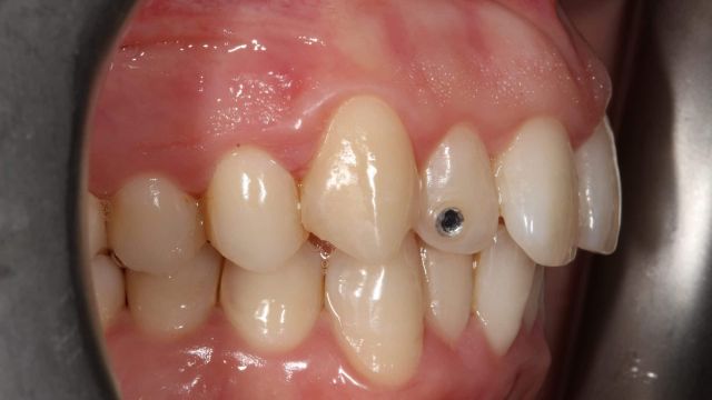 Caso clínico Invisalign