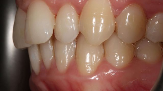 Caso clínico Invisalign