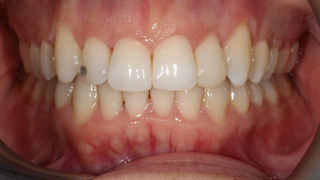 Caso clínico Invisalign