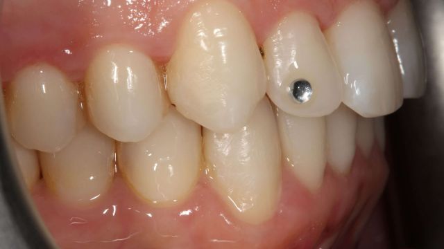 Caso clínico Invisalign