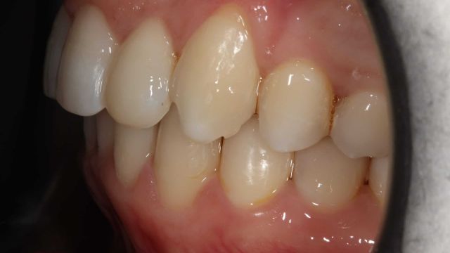 Caso clínico Invisalign