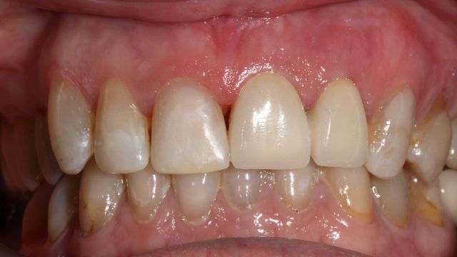 Caso clínico prótesis dentales, resultado final