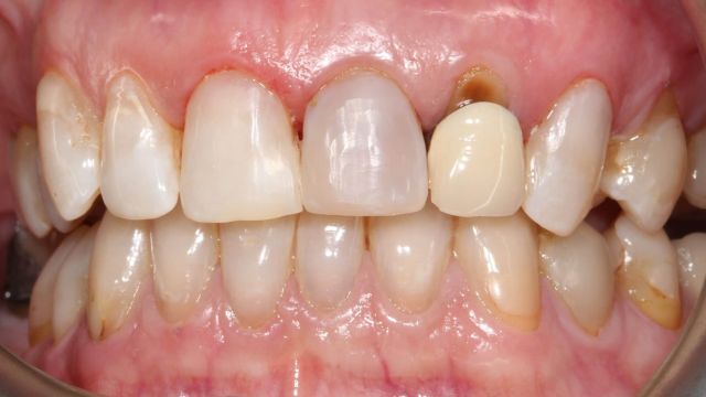 Caso clínico 2 prótesis dentales Sabadell
