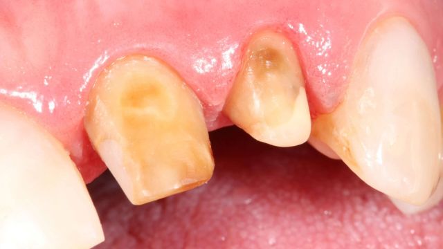 Caso clínico 2 prótesis dentales Sabadell