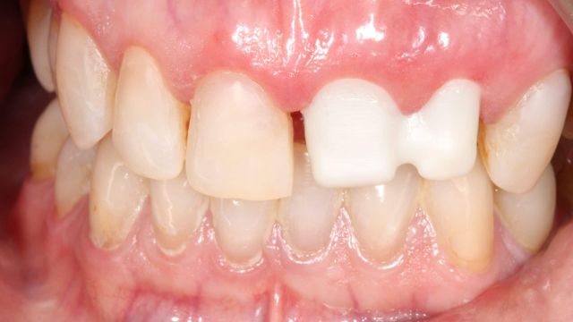 Caso clínico 2 prótesis dentales Sabadell