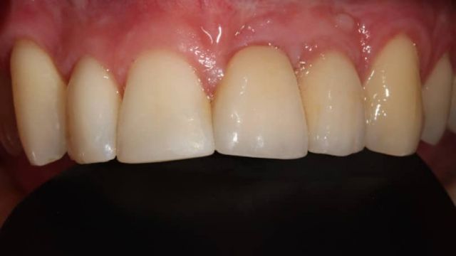 DESPUES CIRUGIA BUCAL