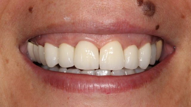Resultado final fundas dentales de zirconio