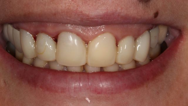 Caso clínico de prótesis dentales