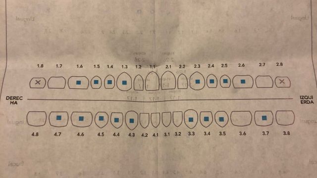 Tratamiento invisalign paso a paso