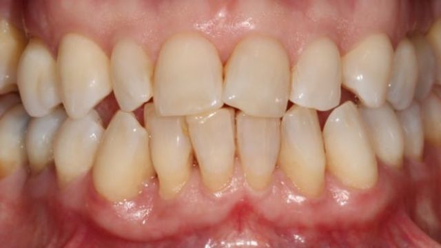Caso Clínico Invisalign 2