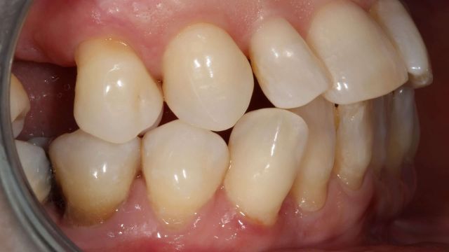 Caso Clínico Invisalign 2