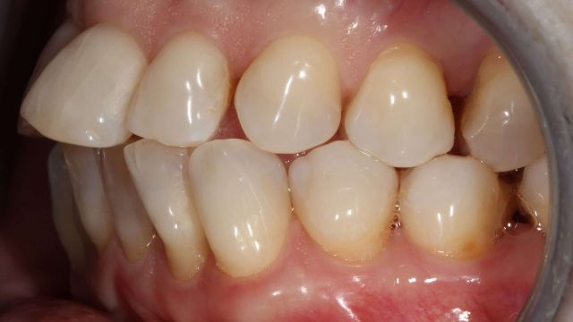 Caso Clínico Invisalign 2