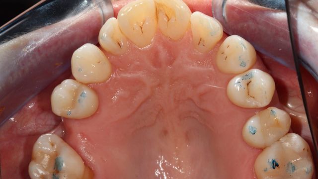 Caso Clínico Invisalign 2