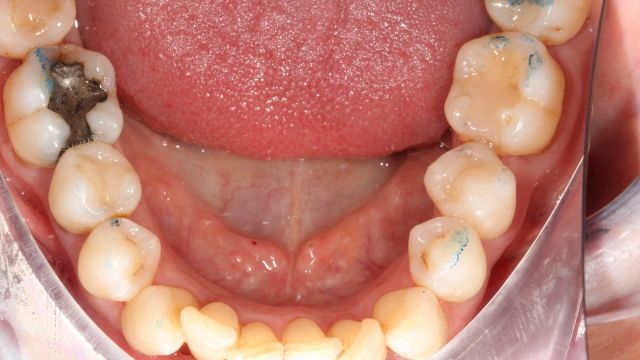 Caso Clínico Invisalign 2