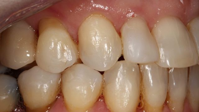 Caso Clínico Invisalign 2