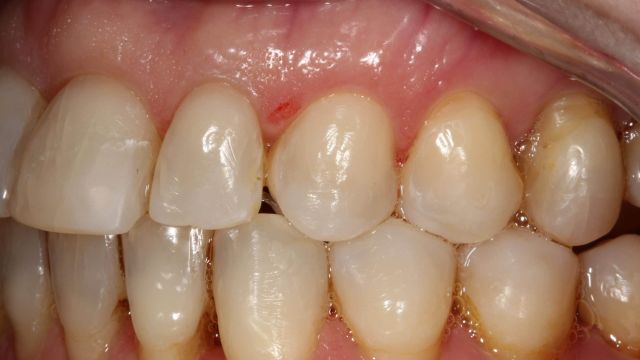Caso Clínico Invisalign 2