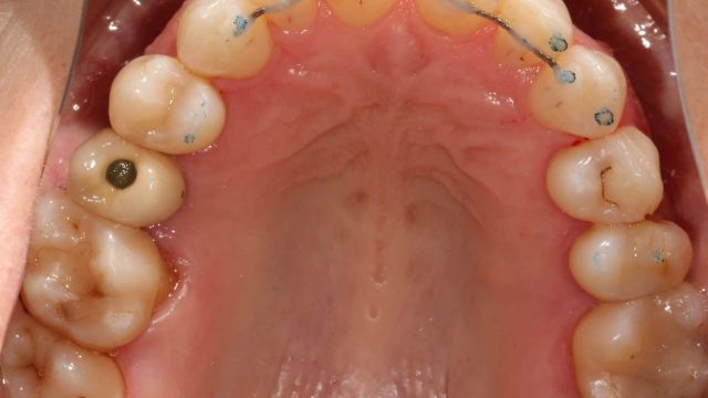 Caso Clínico Invisalign 2