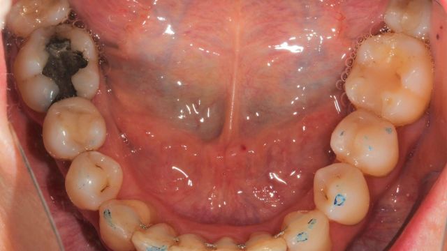 Caso Clínico Invisalign 2