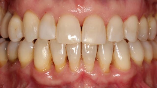 Caso Clínico Invisalign 2
