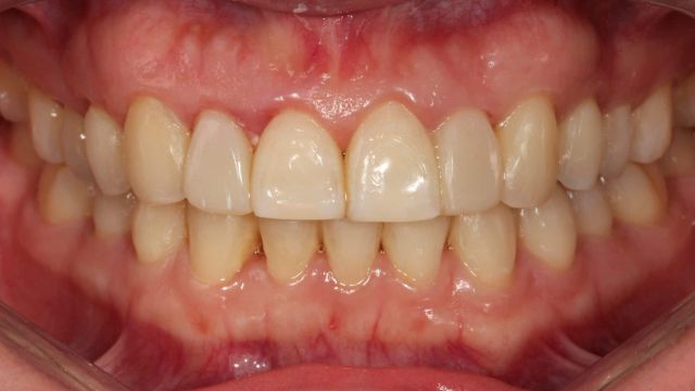 Caso Clínico Invisalign resultado final sonrisa