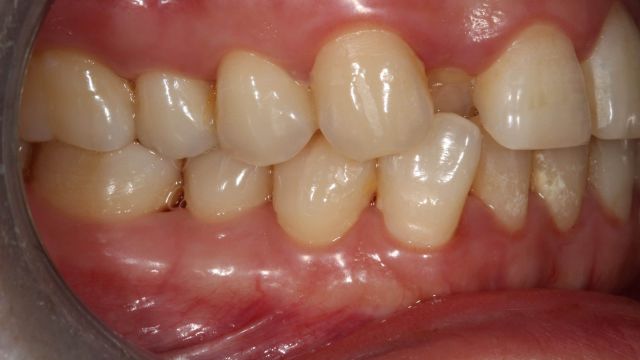 Caso Clínico Invisalign situación inicial lateral