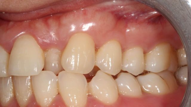 Caso Clínico Invisalign 3 situación inicial lateral 2