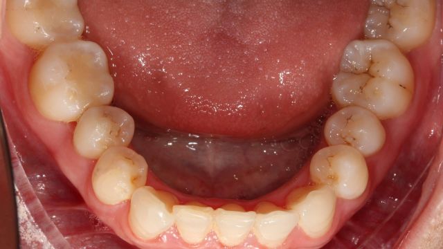 Caso Clínico Invisalign situación inicial inferior