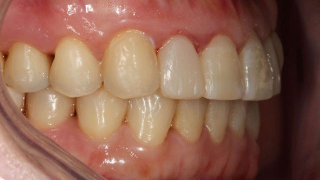 Caso Clínico Invisalign resultado