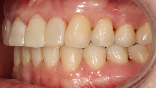Caso Clínico Invisalign resultado final lateral 2