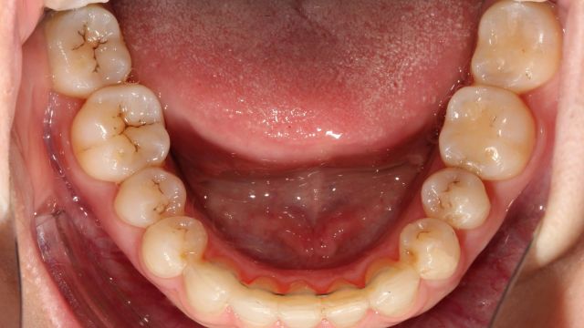 Caso Clínico Invisalign resultado final inferior