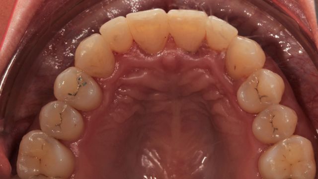 Caso Clínico Invisalign resultado final superior